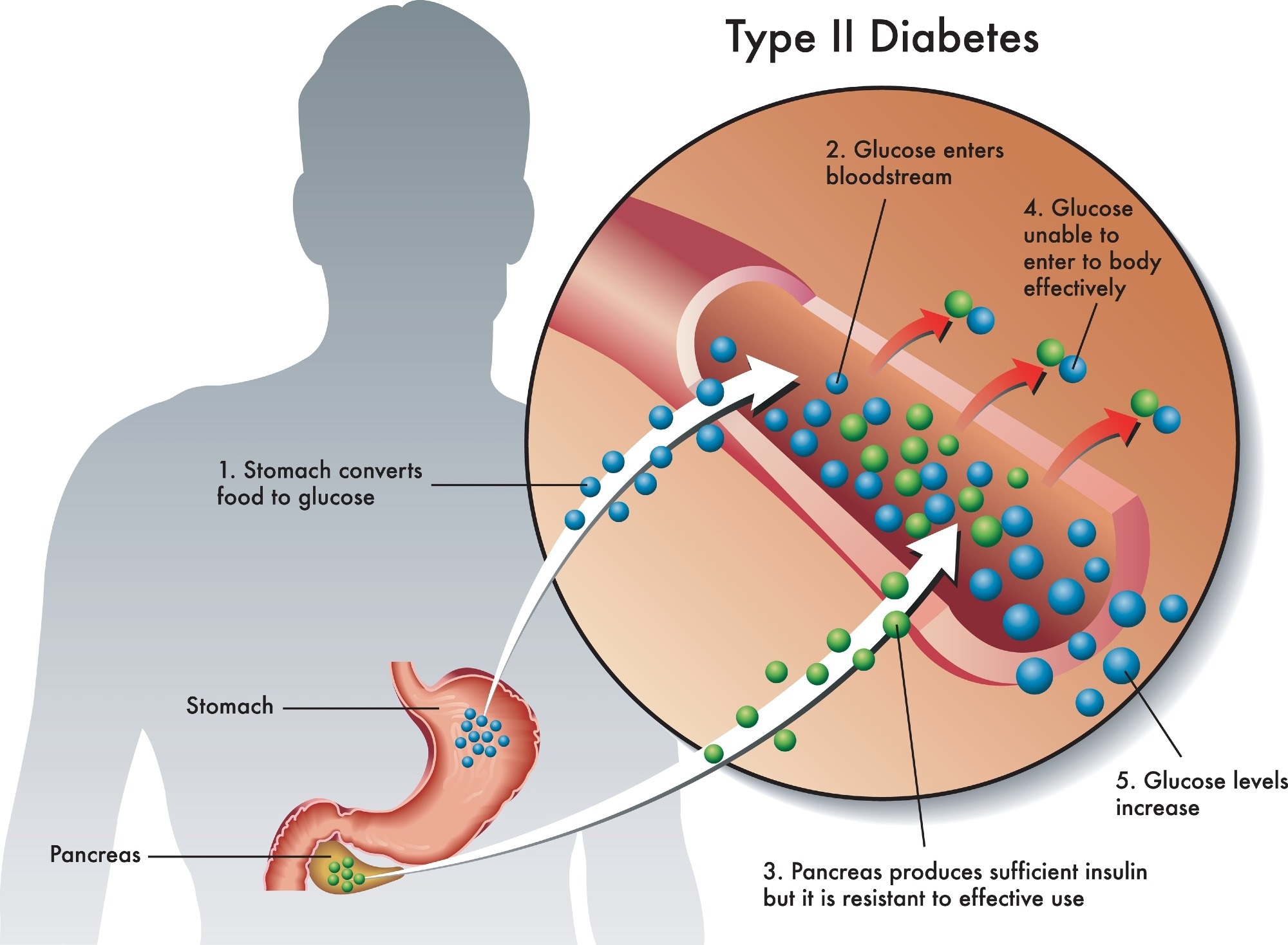 Medical illustration of the symptoms of type 2 diabetes. Image Credit: rob9000/Shutterstock.com