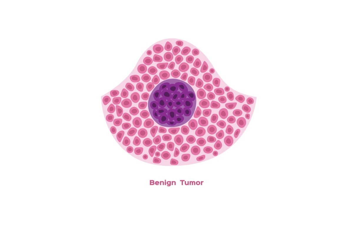 Infantile myofibromatosis is a benign tumor that normally develops during infancy and childhood. Image Credit: gritsalak karalak/Shutterstock