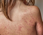 Why Measles Is Making a Comeback Despite Available Vaccines