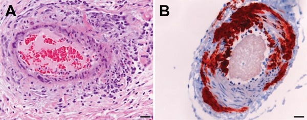 Histologic and immunohistologic findings in Hendra virus–infected horse tissue. A) Hematoxylin and eosin staining shows systemic vasculitis affecting the lung. B) Immunohistologic examination, using polyclonal rabbit anti-Nipah N protein, indicates Hendra virus antigen in a blood vessel in the brain. Scale bars represent 50 μm. 15