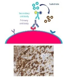 Antibody-mediated fluorescent or chromogenic stains mark the presence and location in the solid tumor.