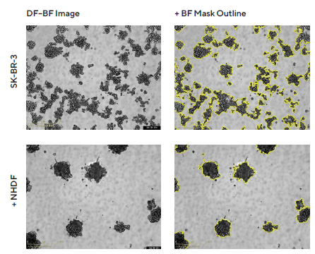 Introducing real-time live-cell analysis with The Incucyte® live-cell analysis system Morphology observations with Incucyte® DF-BF images and quantification of multi-spheroid size and kinetic growth using real-time analysis. SK-BR-3 cells were seeded in flat bottom, 96-well plates on a bed of Matrigel in mono- or co-culture with NHDFs (1:1 ratio, 1,000 cells/well for each) and multi-spheroids (MS) allowed to form (3 d). Incucyte® extended depth of focus Brightfield (DF Brightfield) images (8 d post cell seeding) of SK-BR-3 MS in mono- or co-culture with NHDFs. Brightfield outline mask shown in yellow. Note, the influence of NHDFs on SK-BR-3 MS morphology and size (Total Area). Time course plots show the individual well Total Brightfield Object Area (μm2) (y-axis) over time (h) (x-axis) and illustrate cell type specific kinetic growth profiles for a range of breast tumor MS co-cultured with NHDFs. Data were collected over 192 h period at 6 h intervals. Each data point represents mean ± SEM,