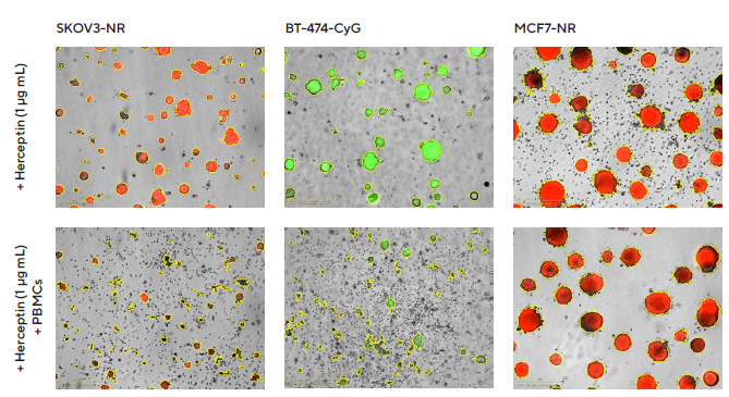 Introducing real-time live-cell analysis with The Incucyte® live-cell analysis system Impact of Herceptin-induced PBMCs on multi-spheroid proliferation. Tumor cells either stably expressing nuclear restricted RFP (SKOV3-NR, MCF7-NR) or cytoplasmically restricted GFP (BT-474-CyG) were seeded in flat bottom 96-well plates (1,000 cells/well on a bed of Matrigel). Multi-spheroids were allowed to form (3 d) prior to addition of freshly isolated PBMCs (E:T, 5:1) and Herceptin. Incucyte® S3 brightfield and fluorescence images (7 d; SKOV3-NR, MCF-NR or 10 d; BT-474-CyG) compare the effect of Herceptin on spheroid proliferation in absence (top panel) and presence (bottom panel) of PBMCs (Brightfield outline mask shown in yellow). Note the loss of fluorescence intensity in HER2- postive (SKOV3 and BT474) multi-spheroids in the presence of PBMCs.