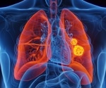Strategies to optimize lung cancer outcomes