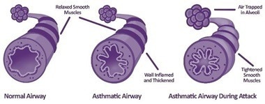Managing asthma in children