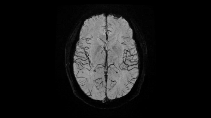80 cm bore MAGNETOM Free.Max