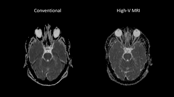 80 cm bore MAGNETOM Free.Max
