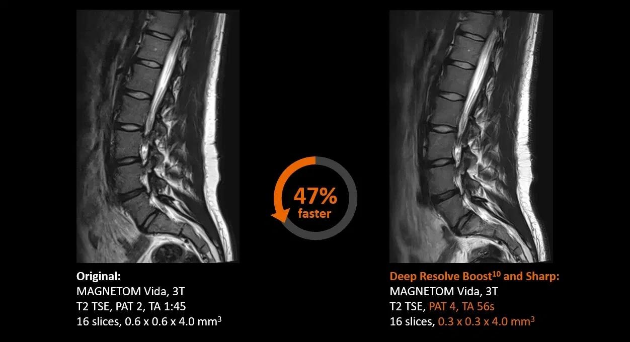 3T MRI scanner MAGNETOM Vida