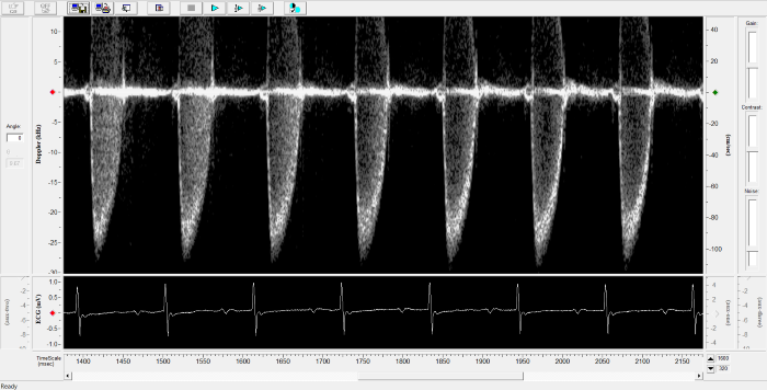 Pulmonary Flow
