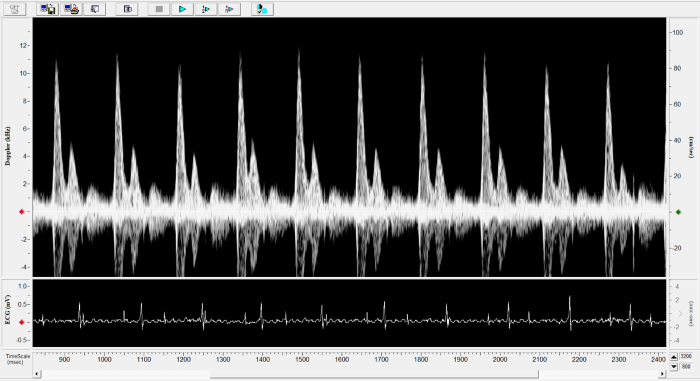 Mouse - Mitral Inflow