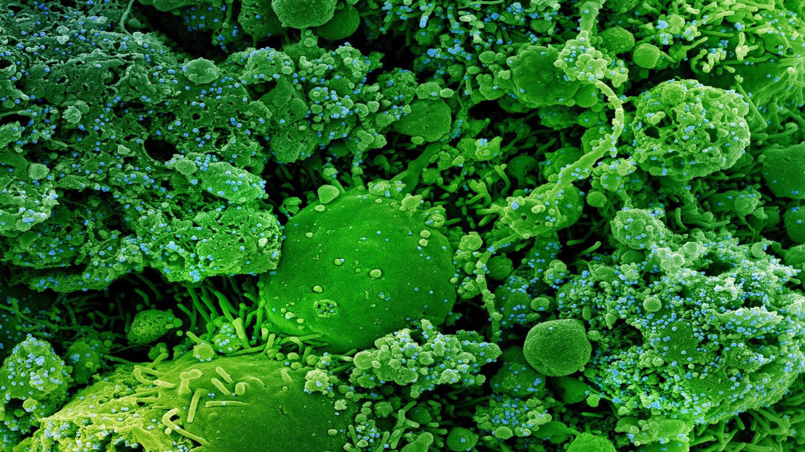 Colorized scanning electron micrograph of chronically infected and partially lysed cells (green) infected with a variant strain of SARS-CoV-2 virus particles (blue), isolated from a patient sample. Image captured at the NIAID Integrated Research Facility (IRF) in Fort Detrick, Maryland. Credit: NIAID