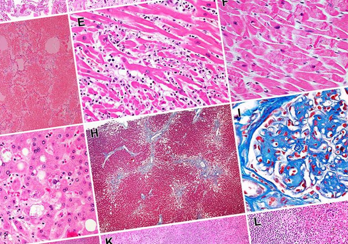Study: SARS-CoV-2 infection and persistence throughout the human body and brain