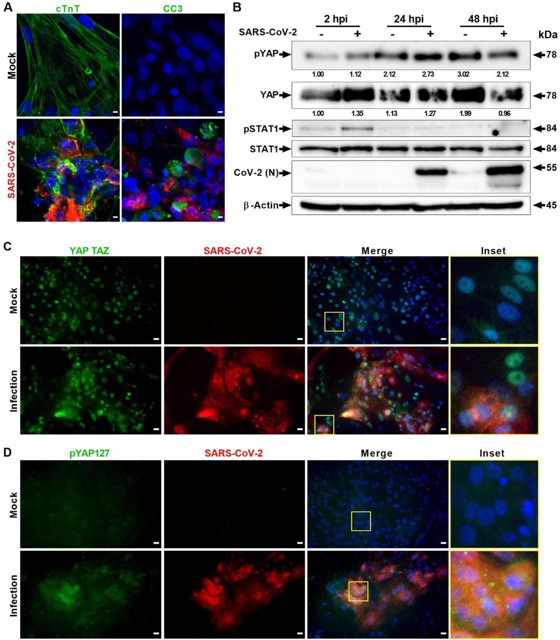 SARS-CoV-2 infection activates Hippo and antiviral STAT pathways in hPSC-CMs. (A) Confocal image analysis of SARS-CoV-2 (red) infected cardiomyocytes shows extensive damage to cTNT positive (green) cells, which undergo apoptotic cell death (green; cleaved caspase 3). Scale bar 5 μm.