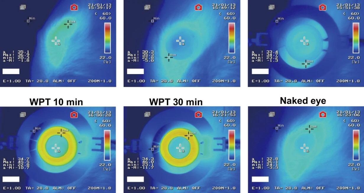 Study: Intelligent wireless theranostic contact lens for electrical sensing and regulation of intraocular pressure