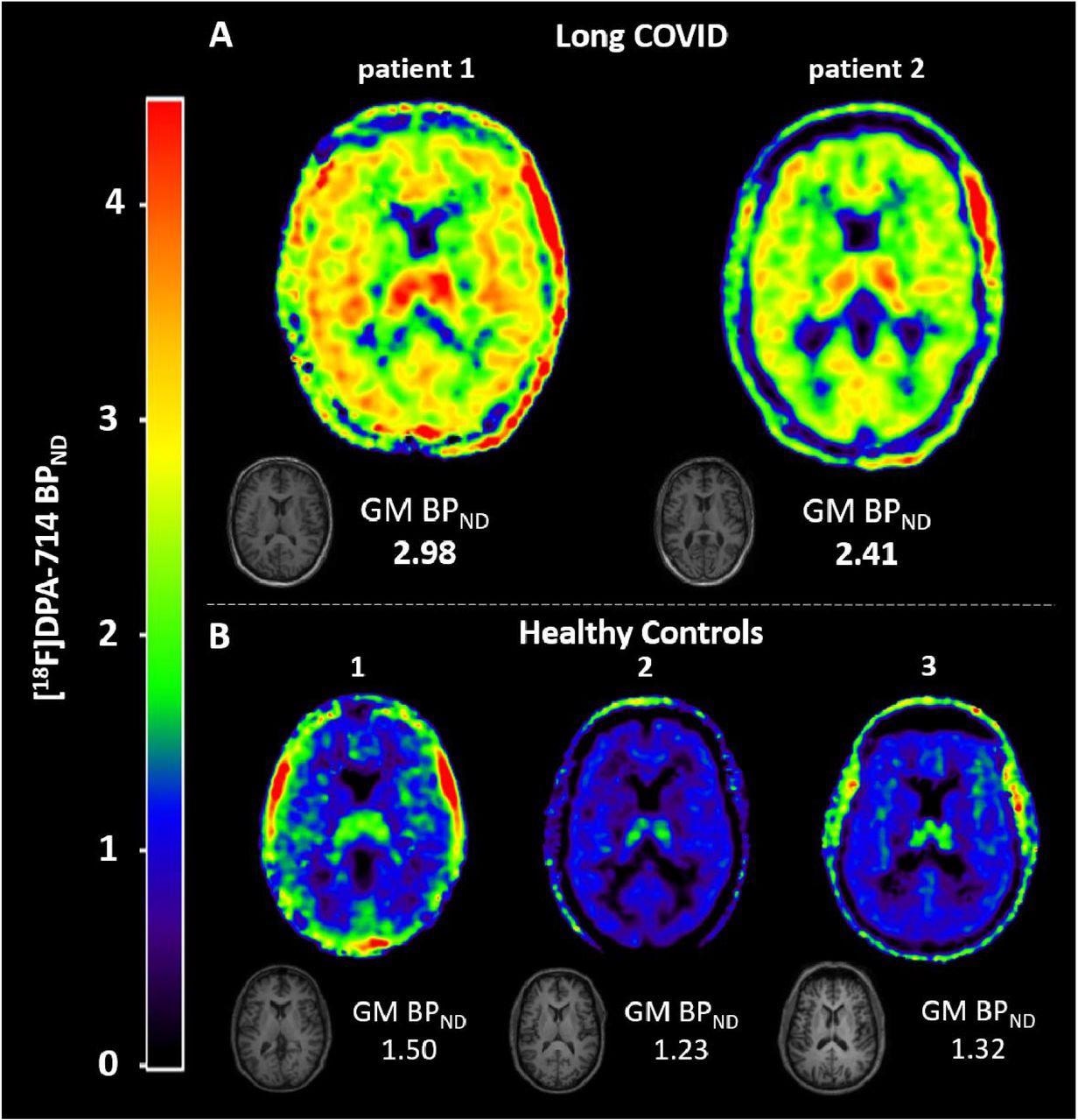 Neuroinflammation in two long COVID patients. To quantify [18F]DPA-714 binding in whole-brain gray matter (GM) we used a plasma input two tissue compartment model with blood volume parameter (2T4k_VB). All quantitative whole-brain grey matter binding potential (BPND (=k3/k4)) values reported are estimated using 2T4k_VB. For visualization purposes we generated volume-of-distribution (VT) images using Logan plot analysis (11), using t* = 10 min, and divided those images by the whole brain grey matter k1/k2 ratio obtained by the plasma input 2T4k_VB model, following subtraction of 1. By doing so, Logan VT images were corrected for the non-displaceable distribution volume resulting in BPND (=k3/k4) images for illustrative purposes. (A) T1-weighted MRI and parametric images of [18F]DPA-714 binding in the brain of two long COVID patients. Higher binding potential (BPND) values indicate more tracer binding and thus higher levels of neuroinflammation. Long COVID patient 1 showed severely elevated binding in all brain regions compared to the healthy control subjects. Long COVID patient 2 also showed elevated binding, with higher BPND values than the healthy control subjects. (B) T1-weighted MRI and parametric images of [18F]DPA-714 binding in the brain of three healthy control subjects.