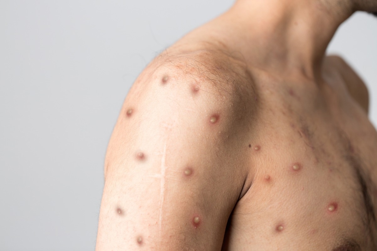 Study: Monkeypox virus: a re-emergent threat to humans. Image Credit: Berkay Ataseven/Shutterstock