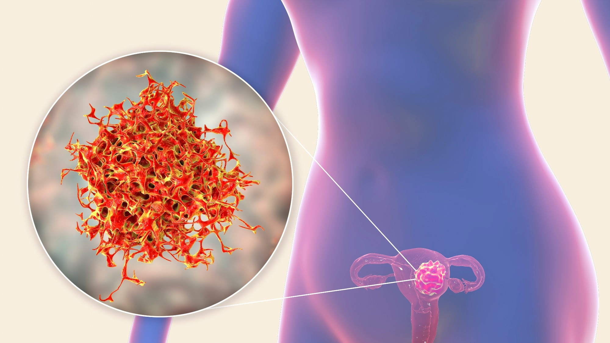 Study: Use of Straighteners and Other Hair Products and Incident Uterine Cancer.  Image Credit: Kateryna Kon / Shutterstock