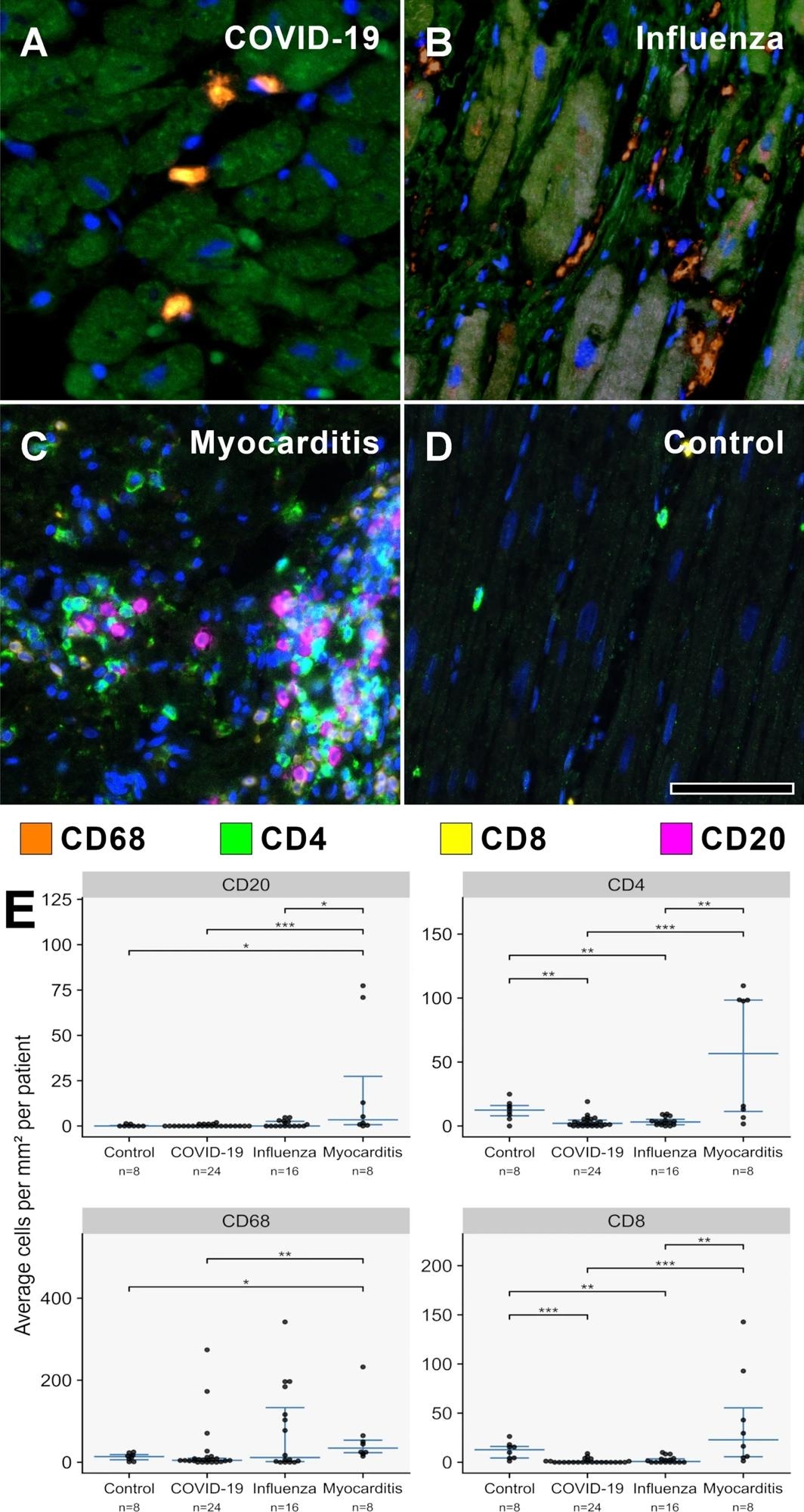 A–D MPX staining of cardiac tissue depicting CD68 + macrophages in orange, CD4 + T helper cells in green, CD8 + cytotoxic T cells in yellow, and CD20 + B-cells in magenta. All infected hearts (COVID-19, influenza, and lymphocytic non-influenza myocarditis) displayed a prominent infiltrate of CD68 + macrophages. While COVID-19 A (COVID-19 patient ID 24) and influenza, B (Influenza patient ID 9) hearts showed nearly absent lymphocytic infiltrate, lymphocytic non-influenza myocarditis, C (Myocarditis patient ID 5) was characterized by a mixed, T-cell dominated infiltrate. Non-infected control hearts, D (Control patient ID 1) showed markedly less inflammatory cells with a mixed population of macrophages and predominant t-cells and only scarce B-cells. Magnification 400x. Scale bars = 100 µm. E Histogram of the inflammatory cell infiltrates (CD20, CD4, CD68, CD8). Cell counts are normalized to cells per mm2 myocardial tissue. *p < 0.05, **p < 0.01, ***p < 0.001