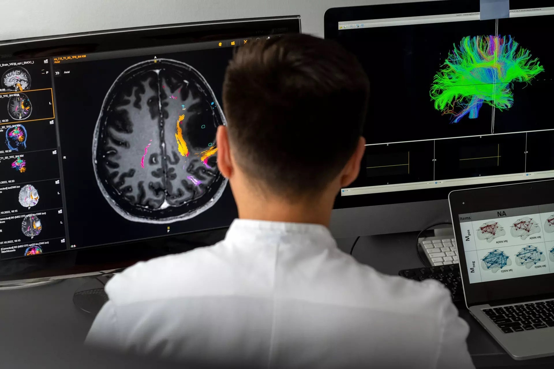 Quantifying the risk of surgery‐related aphasia after brain tumor removal