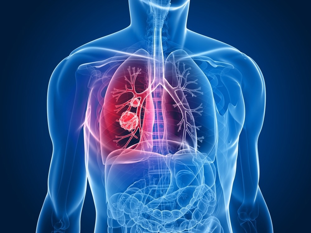 lung cancer