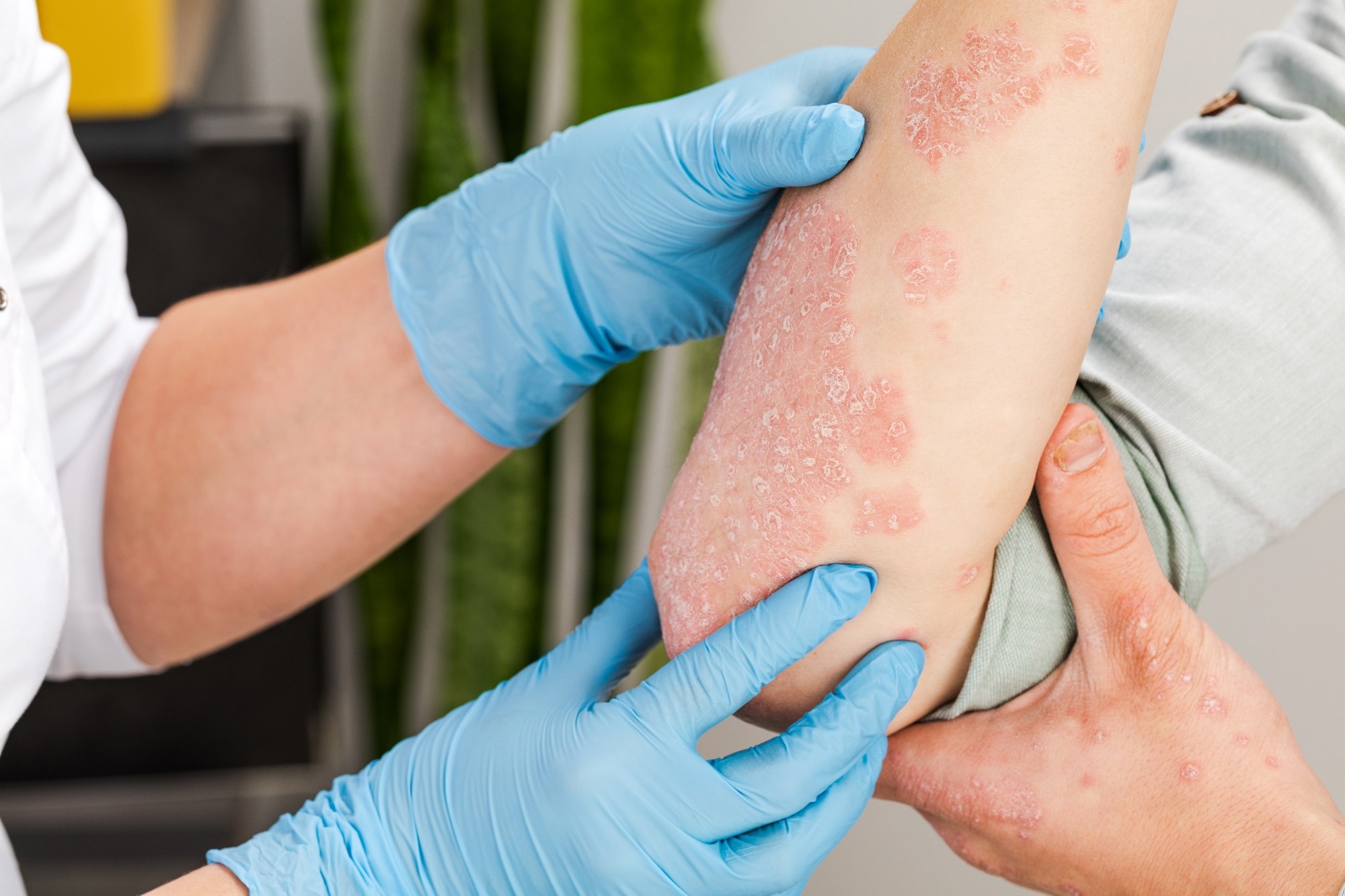 Study: Insights into Nutritional Strategies in Psoriasis. Image Credit: Fuss Sergey/Shutterstock.com