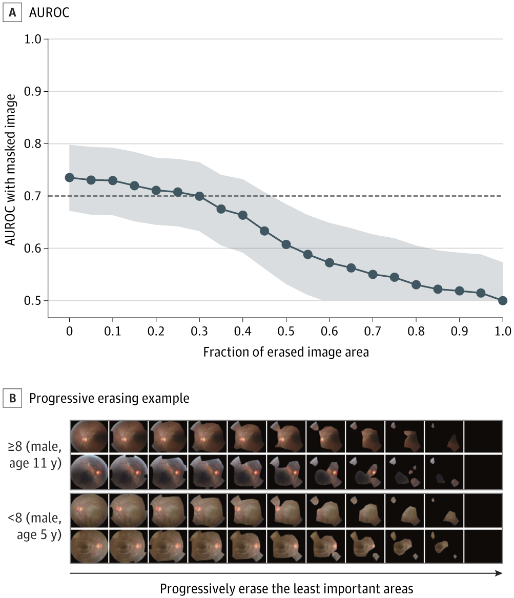 Quantitative Validation of the Heat Map With the Progressive Erasing Technique for ADOS-2–Based Symptom Severity Screening. A, Area under the receiver operating characteristic curve (AUROC) with shaded 95% CI obtained from masked images. B, Progressive erasing for severe autism spectrum disorder (ASD) and mild to moderate ASD. ADOS-2 indicates Autism Diagnostic Observation Schedule–Second Edition.
