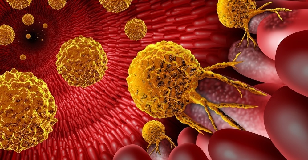 Study: Global, regional, and national lifetime risks of developing and dying from gastrointestinal cancers in 185 countries: a population-based systematic analysis of GLOBOCAN. Image Credit: Lightspring/Shutterstock.com