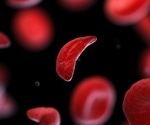 Review of traditional treatments and novel nutritional interventions for sickle cell disease