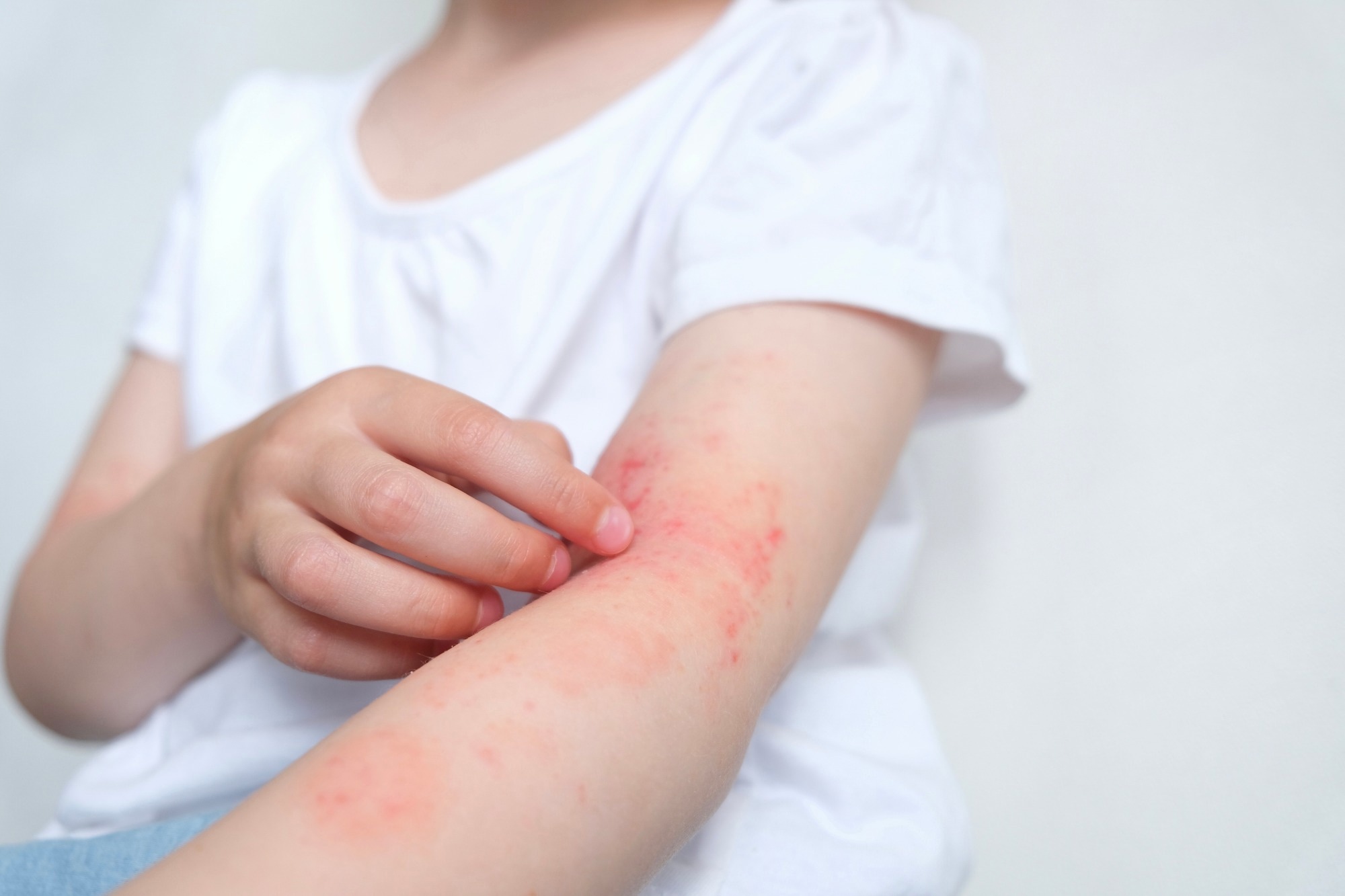 Study: Neonatal Vitamin D and Associations with Longitudinal Changes of Eczema up to 25 Years of Age. Image Credit: marishkaSm / Shutterstock