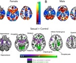 Study uncovers sex differences in brain responses to low sexual desire