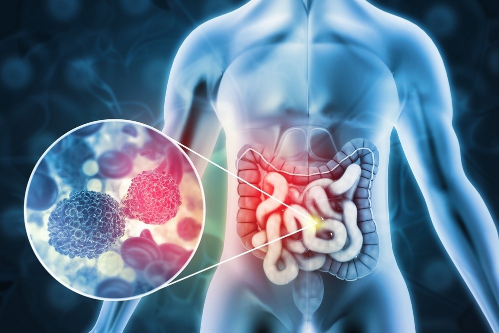 Study: The genomic landscape of 2,023 colorectal cancers. Image Credit: crystal light/Shutterstock.com