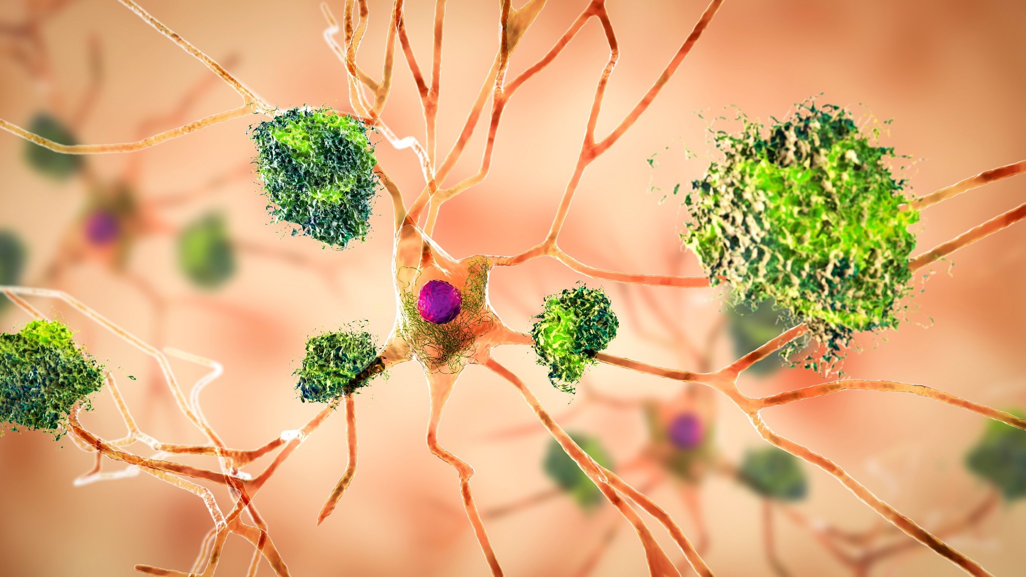 Study: Proteomic changes in Alzheimer disease associated with progressive Aβ plaque and tau tangle pathologiesImage Credit: Kateryna Kon / Shutterstock
