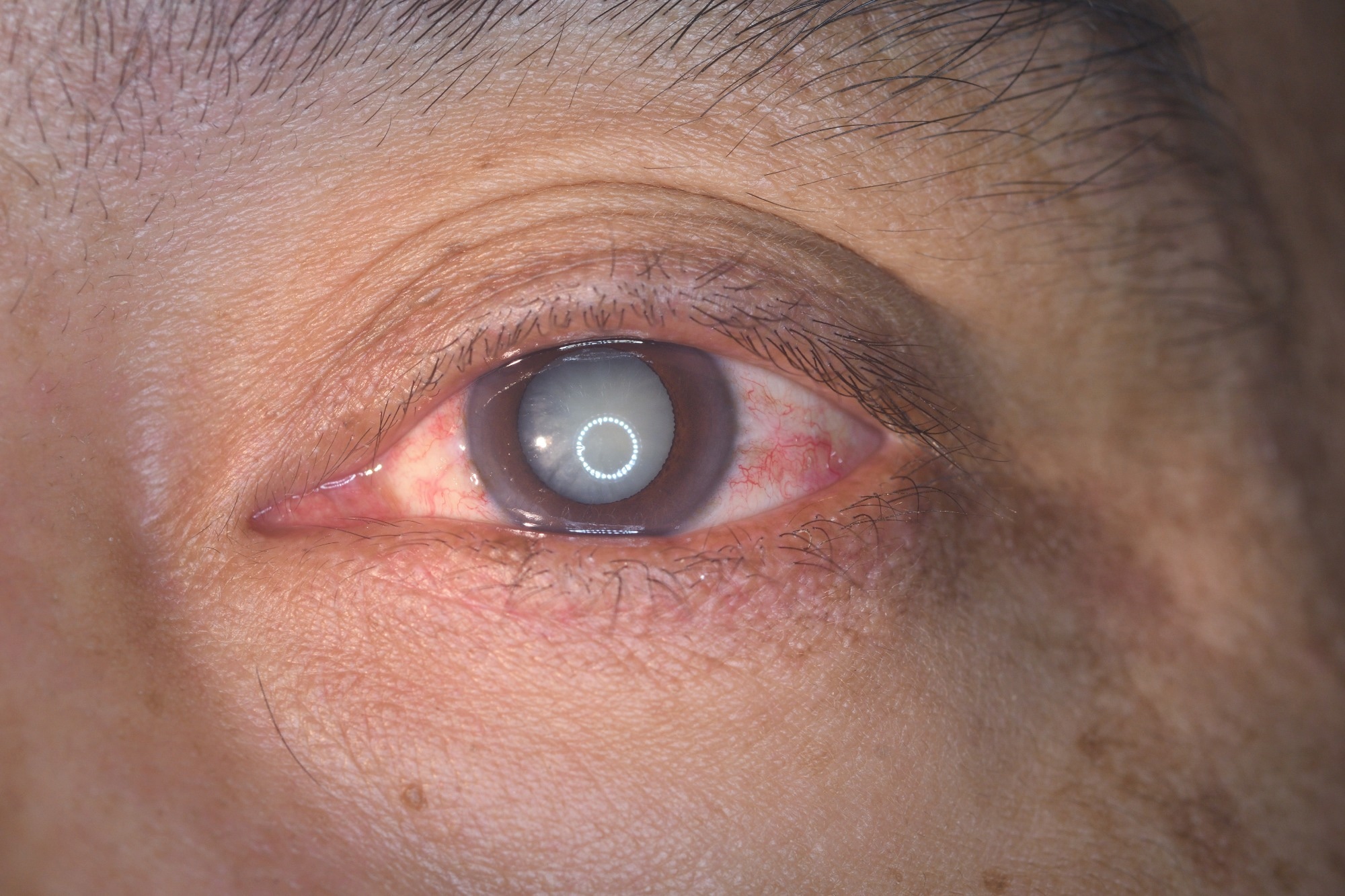 Review: Minimizing Oxidative Stress in the Lens: Alternative Measures for Elevating Glutathione in the Lens to Protect against Cataract. Image Credit: ARZTSAMUI / Shutterstock