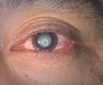 Researchers boost natural defenses to fight cataracts and delay the need for surgery