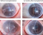 Stem-cell implants restore vision in patients with corneal stem cell deficiency