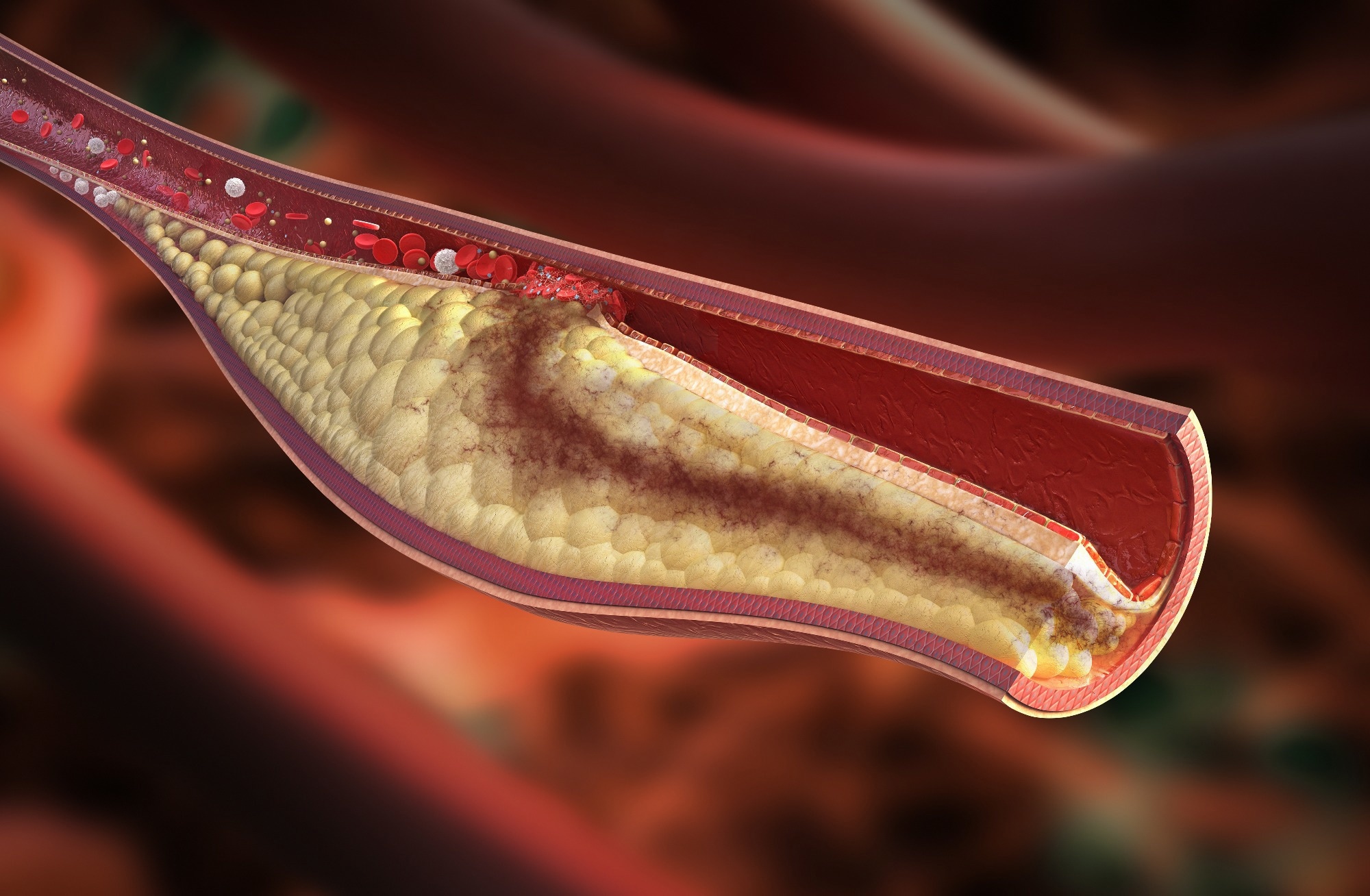 Study: SARS-CoV-2 Infection Association with Atherosclerotic Plaque Progression at Coronary CT Angiography and Adverse Cardiovascular Events. Image Credit: Rocos / Shutterstock