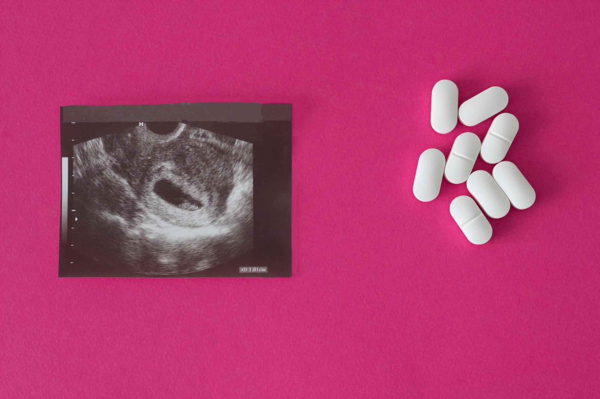Study: First-Trimester Antibiotic Use for Urinary Tract Infection and Risk of Congenital Malformations. Image Credit: HenadziPechan / Shutterstock