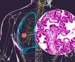 EAGLE model predicts key lung cancer mutations from routine biopsy