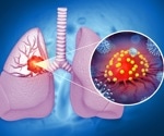 Allergies linked to lower lung cancer risk, new study finds