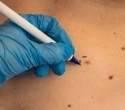 Study reveals early nicotinamide use reduces risk of aggressive skin cancers