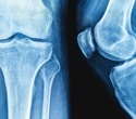 Yogurt’s impact on bone health falls short of fracture protection, review finds