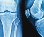Yogurt’s impact on bone health falls short of fracture protection, review finds