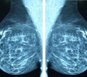 Researchers discover how aggressive breast cancer controls protein production