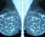 Minimal residual disease monitoring can transform breast cancer care