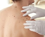 Study reveals how melanoma evolves to resist immunotherapy