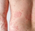 People with eczema can bathe daily or weekly without worrying about flare-ups