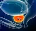 Breakthrough treatment for advanced prostate cancer could eliminate severe side effects