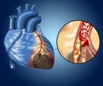 Heart disease can be reduced substantially by regularly treating existing gum infections