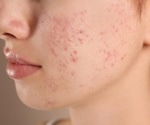Acne and diet: an interview with Dr Katerina Steventon, Research Fellow, HONEI, University of Hull