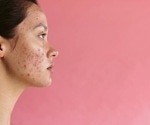 Study reveals widespread unrecognized acne among 35-year-old Finnish women